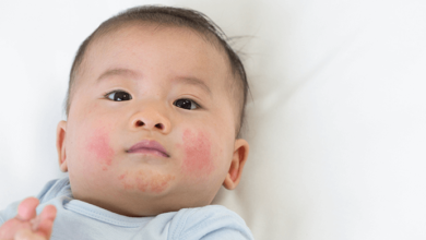 Baby:2zuci6nibv8= Allergic Reaction Rash